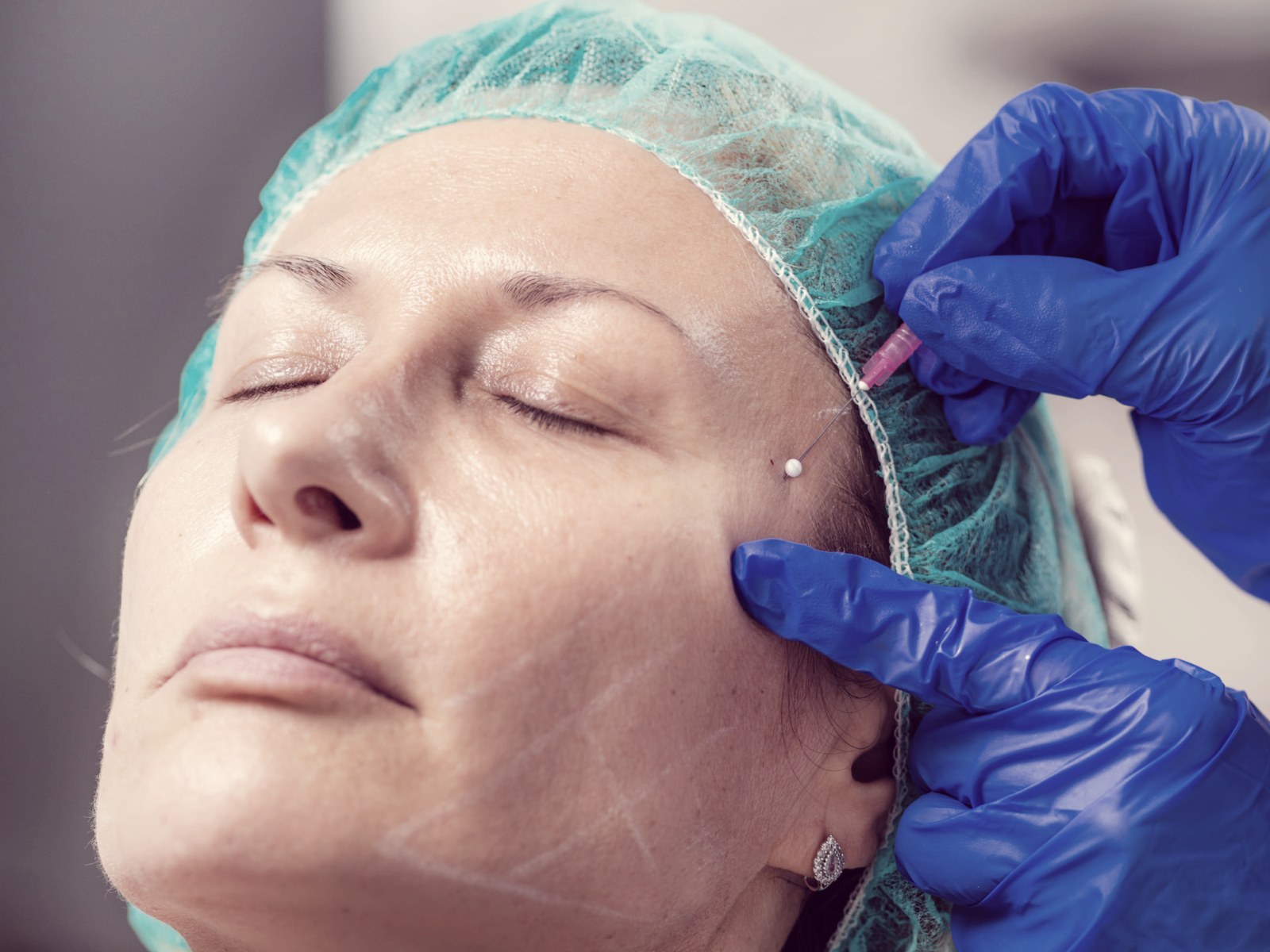 Practitioner in gloves giving a client a facial injectable treatment at a med spa